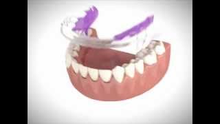 Inman Aligner Introduction Video [upl. by Austin]