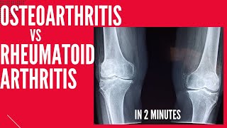 Osteoarthritis vs Rheumatoid arthritis in 2 mins [upl. by Dnaletak804]