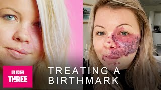 How A Facial Birthmark Is Treated Skin [upl. by Magree]