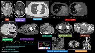 IMAGING IN HERNIAS CASE SPECTRUM [upl. by Eart]