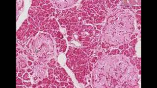 Histopathology Pancreas Type 2 Diabetes mellitus [upl. by Flosser]