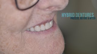 Hybrid DENTURES Process Before and After dentures smile dentistry painting teeth [upl. by Gies]