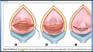 Obstetrics 693 c Steps Of Cesarean Section Incision Delivery of baby repair of CSection Operation [upl. by Fredenburg]