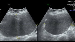 DERMOID OR ENDOMETRIOMA [upl. by Warring929]