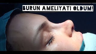 BURUN AMELİYATI OLDUM  EstetikDeviasyon Fotoğraflarla Ameliyat Süreci [upl. by Frierson]