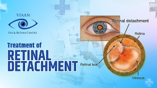 Treatment of Retinal Detachment  Dr Neeraj Sanduja  Retina Specialist  Viaan Eye amp Retina Centre [upl. by Oicam]