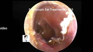 Ear Wax RemovalReview of several cases of cholesteatoma of the external auditory canal [upl. by Hanima]