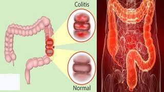 कोलाइटिस बीमारी के है ये लक्षण और संकेत जिसके जरिये आप इसे पहचान सकते हैkolaitis ke lakshan [upl. by Phillida]