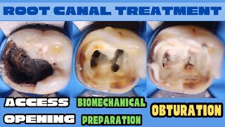 Root Canal Treatment 🔵 Mandibular Molar 🟡Access Opening🟢Biomechanical Preparation ⚪️ Obturation [upl. by Shayn]