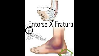 Entorse do Tornozelo com Fratura Luxação TRATAMENTO CONSERVADOR Clínica Fisioterapia Dr Robson Sitta [upl. by Keriann864]