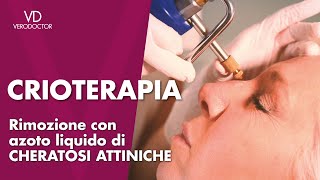 Crioterapia rimozione con azoto liquido di cheratosi attiniche [upl. by Orual]