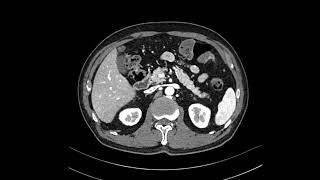 GB adenomyomatosis [upl. by Nonnad]