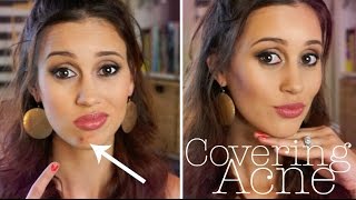 How to Cover a Pimple FLAWLESSLY [upl. by Ludly409]