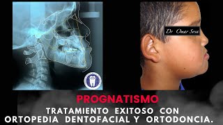 PROGNATISMO MANDIBULAR  Tratamiento exitoso con Ortopedia Dentofacial y Ortodoncia [upl. by Attinahs]