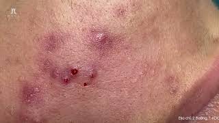 Big Cystic Acne Blackheads Extraction Blackheads amp Milia Whiteheads Removal Pimple Popping [upl. by Kablesh415]