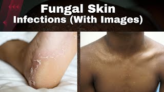 Fungal Skin Infections  Types Symptoms and Treatment With Pictures [upl. by Latnahs]