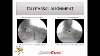 Guide to Misaligned and Flat feet [upl. by Azile496]