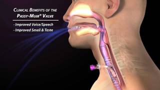 Clinical Benefits of the Passy Muir Valve [upl. by Ecadnac]