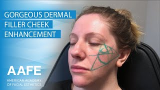 Gorgeous Dermal Filler Cheek Enhancement [upl. by Anelad]