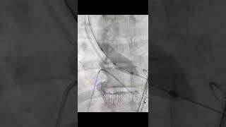 Balloon Aortic Valvuloplasty BAV procedure and details [upl. by Redman]