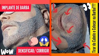 TRANSPLANTE DE BARBA  FIOS BRANCOS padraocmc ♨️ [upl. by Lazar]