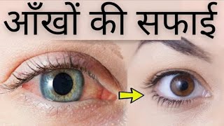 Dorzolamide Hydrochloride amp Timolol Maleate Ophthalmic Solution IPDormideT Eye Dropsग्लूकोमा [upl. by Llekram]