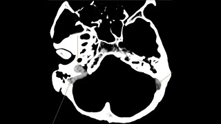 Venus Sinus Thrombosis and Intraventricular haemorrhage  CT CT angiogram and Venogram [upl. by Kreitman]