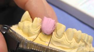 Restoring a tooth Ceramic Buildup [upl. by Walburga858]