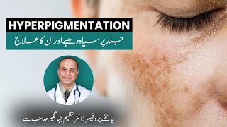 Hyperpigmentation and its treatments explained by Prof Dr Azim Jahangir Khan  Cosmetique [upl. by Fira]