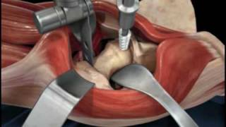 Direct Anterior Approach Hip Replacement [upl. by Shawnee697]