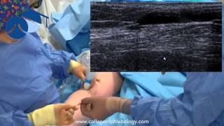 TRLOP closure of perforator veins in varicose vein surgery using NTD [upl. by Allsun]