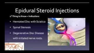 5 Things to Know About Epidural Steroid Injections 602 5076550 [upl. by Polard171]