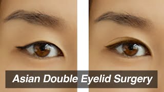 Non Invasive Double Eyelid Procedure  No Surgery No Scar  Bryan Bartolay [upl. by Kerred687]