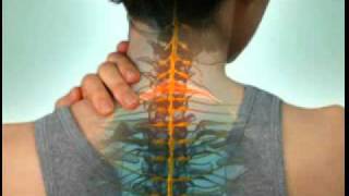 Cervical Radiculopathy  DePuy Videos [upl. by Johnson]