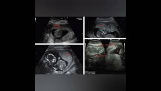 Placental Maturation with Example gynae pregnancy ultrasound medical health trending [upl. by Ivon]