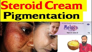 Steroid cream Side effect on face  Pigmentation कैसे ठीक करें ॰॰ Dr Prateek chauhan [upl. by Annauqal]