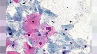 Cervix High grade squamous intraepithelial lesion HSIL Pap smear [upl. by Eerrehc861]