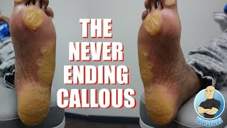 EXTREME UNBELIEVABLE NEVER ENDING THICKEST FOOT CALLUSCALLOUS REMOVAL [upl. by Baelbeer]