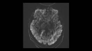 MRI BRAIN TBI Set 7 [upl. by The]