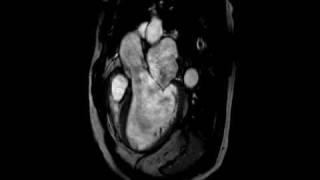 Aortic Regurgitation  Threechamber cine SSFP MR [upl. by Stevena]