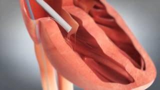 Mercy  St Jude Medical  Animation of NanostimTM Leadless Pacemaker [upl. by Kelcey]