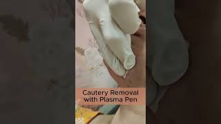 Cautery Removal with Plasma Pen [upl. by Ion188]