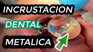 COMO se hacen las INCRUSTACIONES DENTALES METALICAS  Incrustación dental  Restauración de muela 🦷 [upl. by Czarra353]