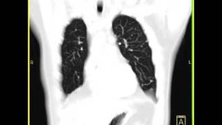 Lung Anatomy Sarcoidosis [upl. by Repsaj]