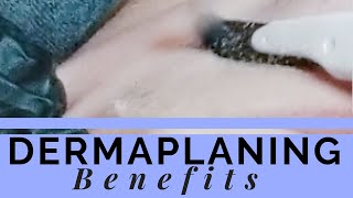 Dermaplaning Facial Benefits [upl. by Ahsilef749]