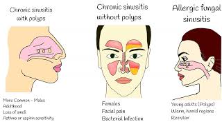 Chronic Sinusitis  Symptoms causes and treatment Sinusitis with polyps Fungal sinusitis [upl. by Jeb210]