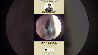 귀지형 콧물 부비동염 축농증 비염 코청소 이비인후과 rhinorrhea rhinitis sinusitis asmr [upl. by Arakaj]