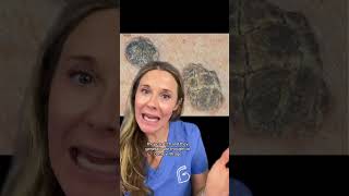 Have you seen these common skin lesions 🎥AUSTIN SKIN DOCS seborrheickeratosis dermatology [upl. by Teddy]