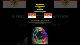 Ekokardiografi  Hipokinesia Inferolateral Dan Inferior [upl. by Oinolopa]