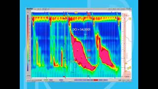 Esophageal Motility Disorders Part 2 [upl. by Germana]